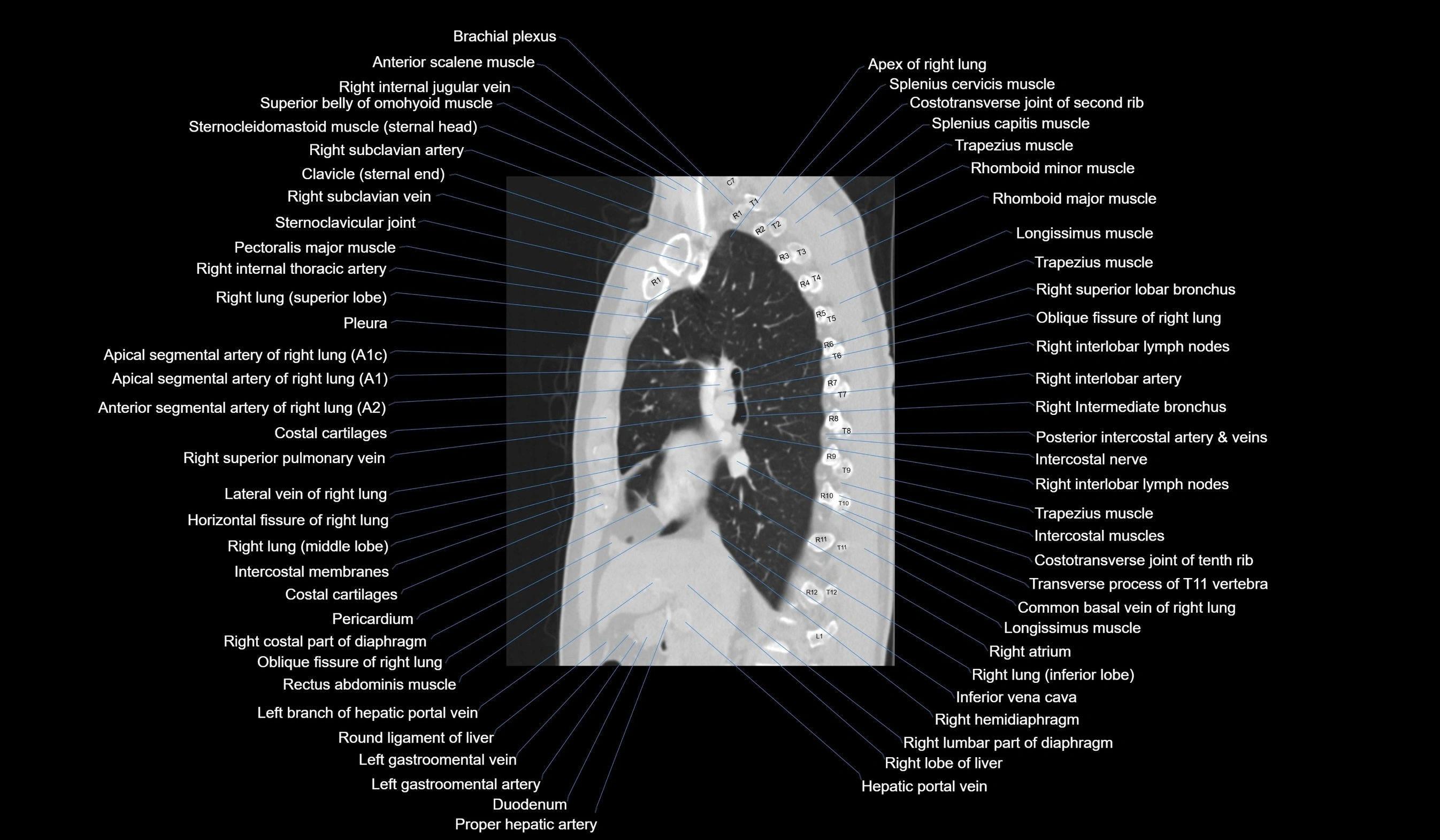 CT chest (thorax) labelled sagittal cross sectional anatomy radiology image-00062.webp